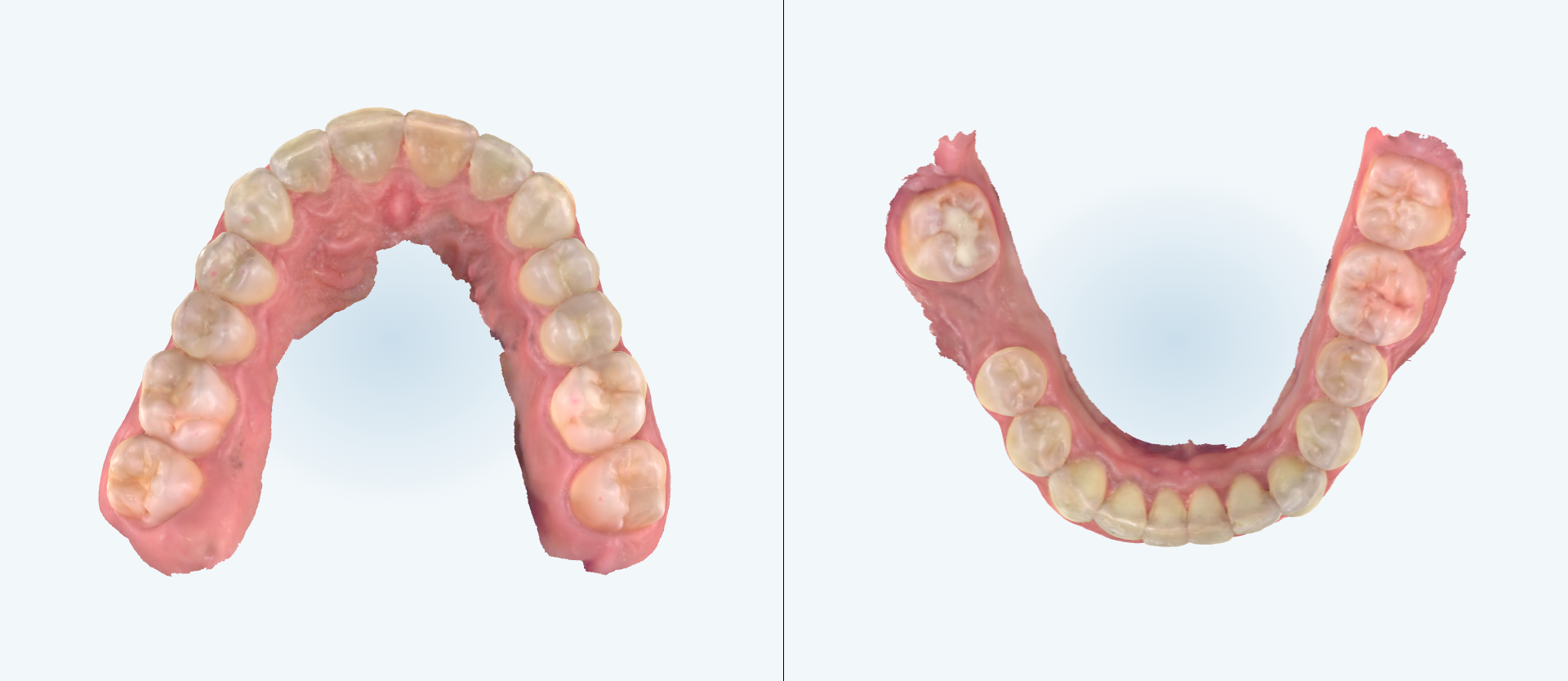 Crowding treatment comparison case 1 after